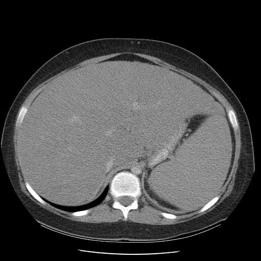 File:Non-Hodgkin lymphoma involving pelvis (Radiopaedia 21281-21197 A 19).jpg