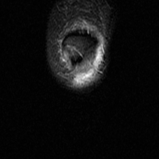 File:Non-displaced patella fracture (Radiopaedia 15932-15582 Coronal STIR 1).jpg