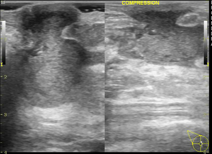 File:Non-lactating breast abscess (Radiopaedia 31045-31754 G 1).jpg