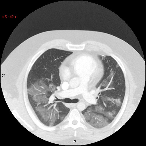 File:Non-specific interstitial pneumonitis (Radiopaedia 27044-27222 Axial lung window 33).jpg