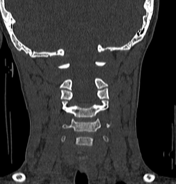File:Normal CT cervical spine - 12-year-old (Radiopaedia 55352-61775 Coronal bone window 105).jpg