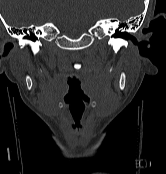 File:Normal CT cervical spine - 12-year-old (Radiopaedia 55352-61775 Coronal bone window 17).jpg