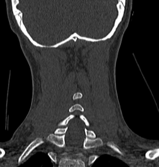 File:Normal CT cervical spine - 12-year-old (Radiopaedia 55352-61775 Coronal bone window 174).jpg