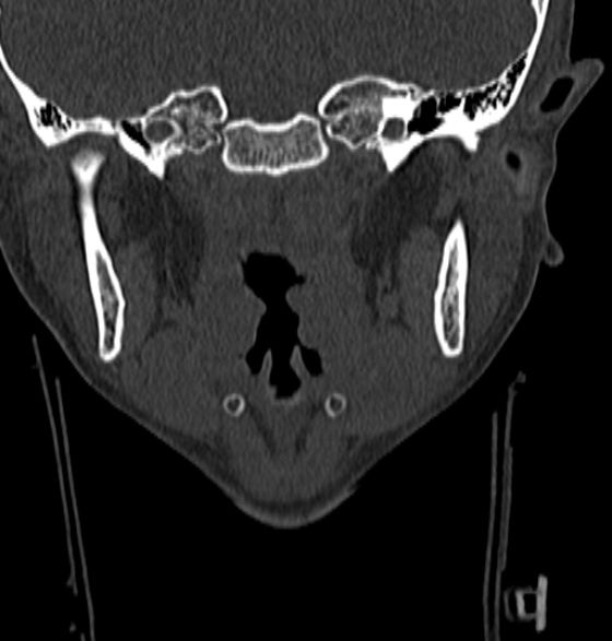 File:Normal CT cervical spine - 12-year-old (Radiopaedia 55352-61775 Coronal bone window 3).jpg