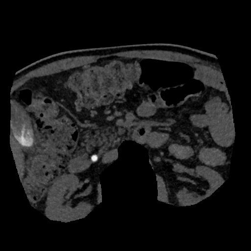 File:Normal CT intravenous cholangiogram (Radiopaedia 38199-40208 Axial IVC (MIP) 14).png