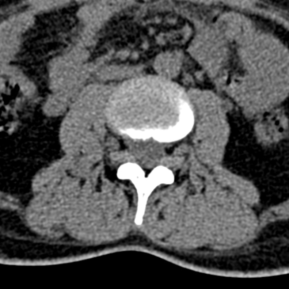 Normal CT lumbar spine (Radiopaedia 53981-60118 Axial non-contrast 53).jpg