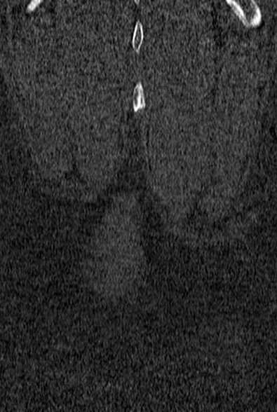 Normal CT lumbar spine (Radiopaedia 53981-60118 Coronal bone window 77).jpg