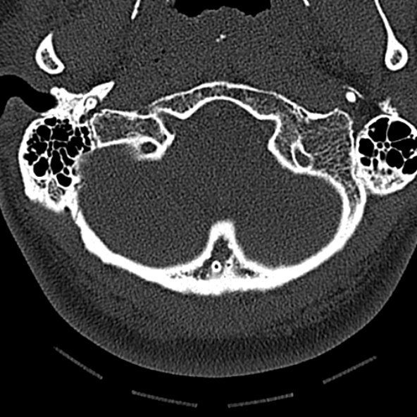 Normal CT of the cervical spine (Radiopaedia 53322-59305 Axial bone window 33).jpg