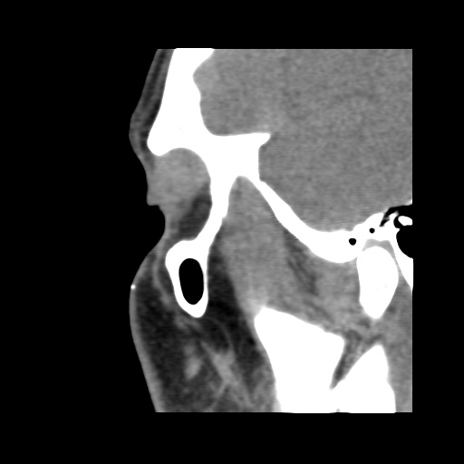 Normal CT paranasal sinuses (Radiopaedia 42286-45390 F 120).jpg