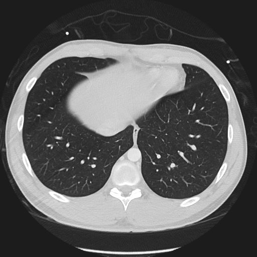 Normal CT pulmonary veins (pre RF ablation) (Radiopaedia 41748-44702 Axial lung window 50).png