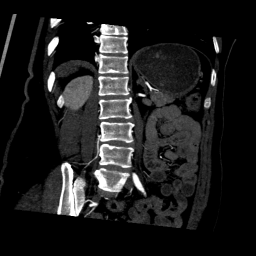 File:Normal CT renal artery angiogram (Radiopaedia 38727-40889 D 16).png