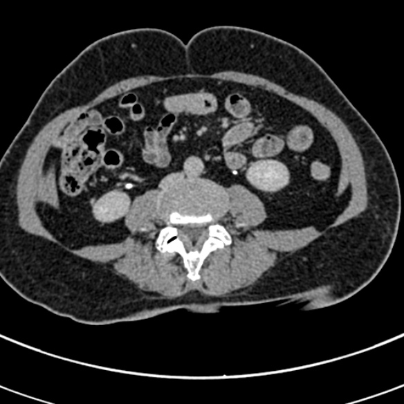 File:Normal CT split bolus study of the renal tract (Radiopaedia 48631-53634 Axial split bolus 151).jpg