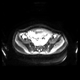 Normal MRI abdomen in pregnancy (Radiopaedia 88001-104541 Axial DWI 11).jpg