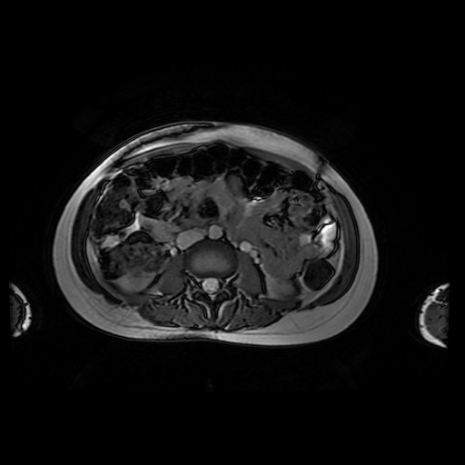 File:Normal MRI abdomen in pregnancy (Radiopaedia 88001-104541 Axial Gradient Echo 27).jpg