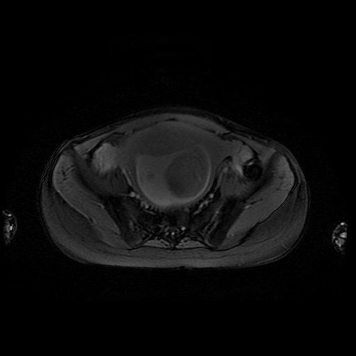 File:Normal MRI abdomen in pregnancy (Radiopaedia 88001-104541 D 43).jpg