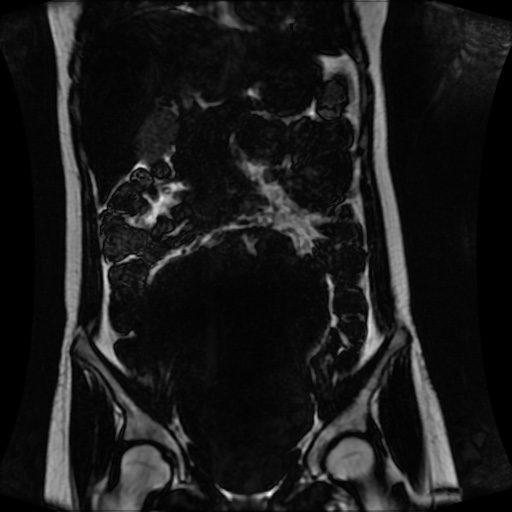 Normal MRI abdomen in pregnancy (Radiopaedia 88001-104541 N 63).jpg