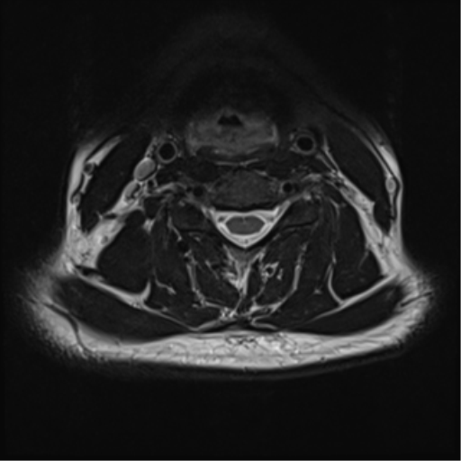 File:Normal MRI cervical spine (infection protocol) (Radiopaedia 53916-60039 Axial T2 29).png