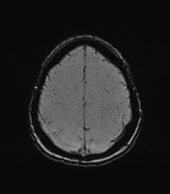 Normal brain MRI (TLE protocol) (Radiopaedia 40748-43405 Axial SWI 72).png