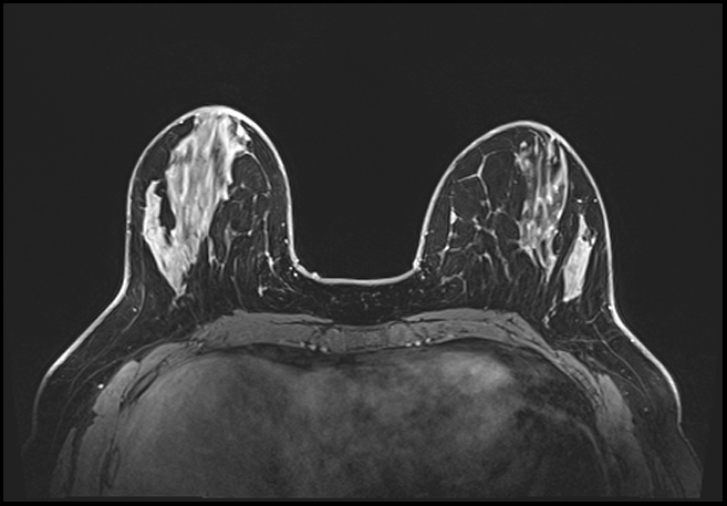 Normal breast MRI - dense breasts (Radiopaedia 80454-93850 C 77).jpg