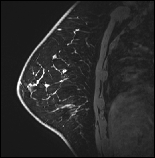 Normal breast MRI - dense breasts (Radiopaedia 80454-93850 I 132).jpg