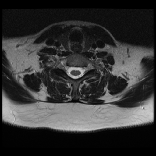 File:Normal cervical and thoracic spine MRI (Radiopaedia 35630-37156 Axial T2 11).png