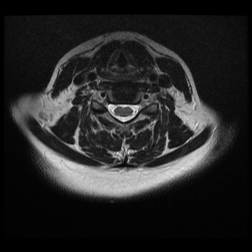 File:Normal cervical and thoracic spine MRI (Radiopaedia 35630-37156 Axial T2 16).png