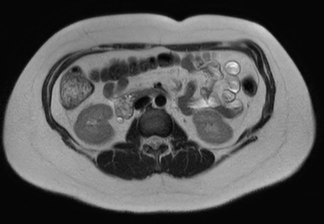 File:Normal liver MRI with Gadolinium (Radiopaedia 58913-66163 Axial T2 9).jpg