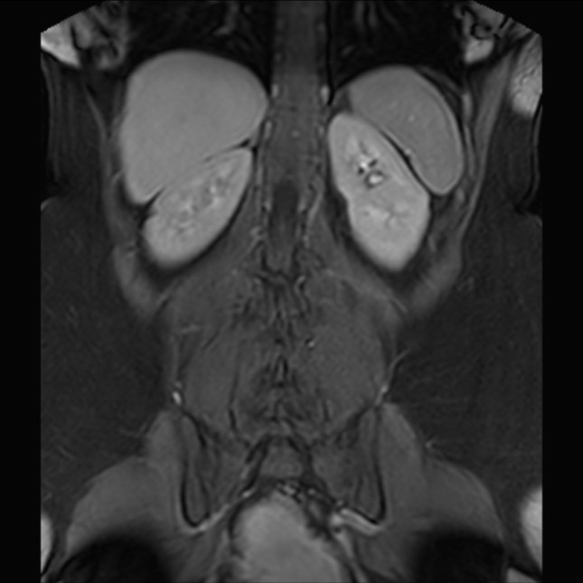Normal liver MRI with Gadolinium (Radiopaedia 58913-66163 P 65).jpg