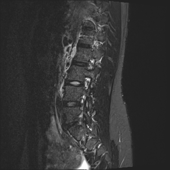 File:Normal lumbar spine MRI- 3 T (Radiopaedia 53280-59250 Sagittal STIR 18).jpg