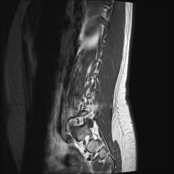 File:Normal lumbar spine MRI- 3 T (Radiopaedia 53280-59250 Sagittal T1 5).jpg