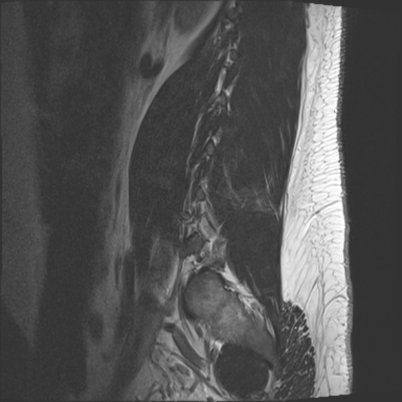 File:Normal lumbar spine MRI (Radiopaedia 47857-52609 Sagittal T2 19).jpg