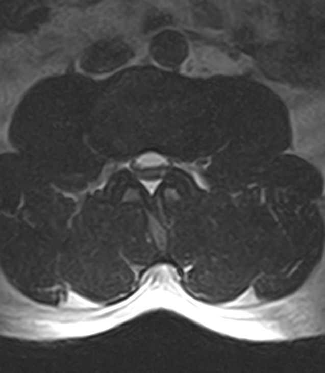 Normal lumbar spine MRI - low-field MRI scanner (Radiopaedia 40976-43699 Axial T2 49).jpg