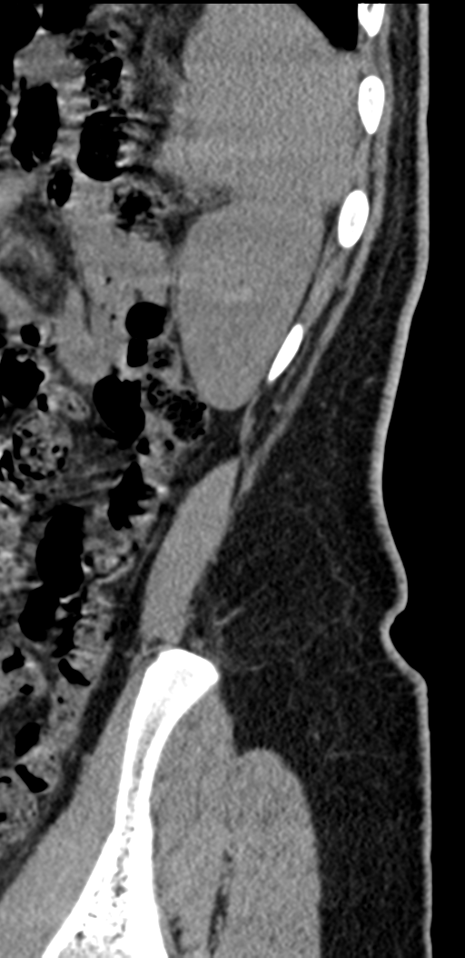 Normal lumbosacral CT (Radiopaedia 37923-39867 E 6).png