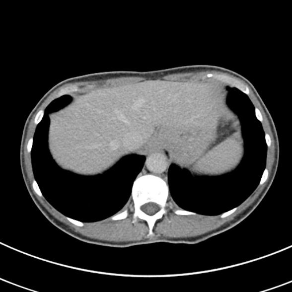 File:Normal multiphase CT liver (Radiopaedia 38026-39996 Axial C+ delayed 10).jpg