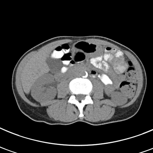 File:Normal multiphase CT liver (Radiopaedia 38026-39996 Axial non-contrast 41).jpg