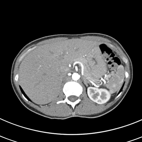 File:Normal multiphase CT liver (Radiopaedia 38026-39996 B 20).jpg