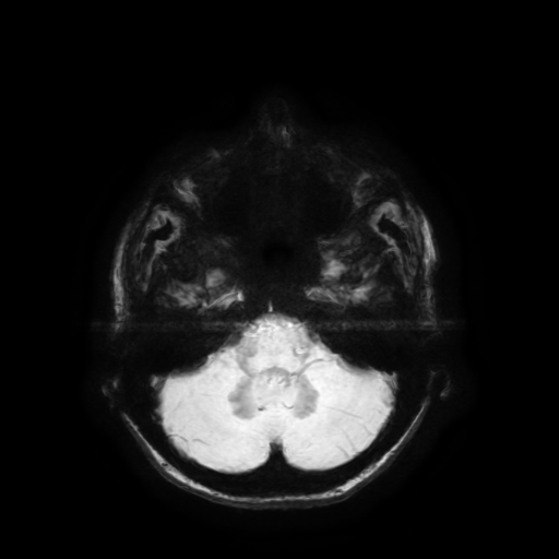 Normal noncontrast MR venography (Radiopaedia 87578-103957 Axial SWI 61).jpg