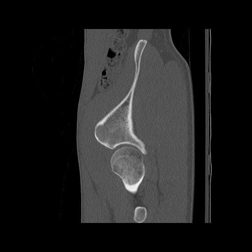 Normal pelvis (Radiopaedia 51473-57238 Sagittal bone window 29).jpg