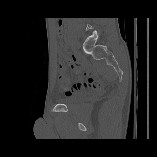 Normal pelvis (Radiopaedia 51473-57238 Sagittal bone window 61).jpg