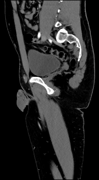 Normal pelvis CT angiogram (Radiopaedia 84966-100481 C 46).jpg