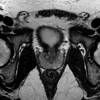 File:Normal prostate (MRI) (Radiopaedia 29986-30535 Axial T2 9).jpg