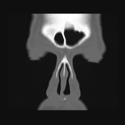 Normal sinus CT (annotated) (Radiopaedia 78917-91810 Coronal bone window 13).jpg