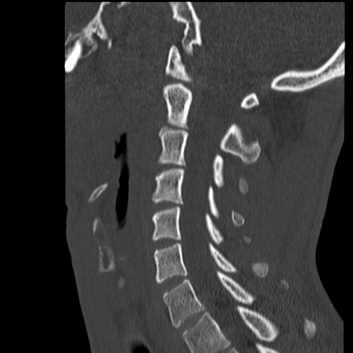 File:Normal trauma cervical spine (Radiopaedia 41017-43760 Sagittal bone window 28).png