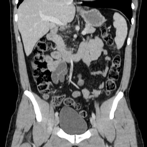 File:Obstructing ureteric calculus (Radiopaedia 18615-18514 C 34).jpg