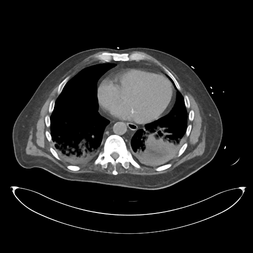 File:Obstructive pyelonephritis (Radiopaedia 46411-50844 Axial non-contrast 8).png