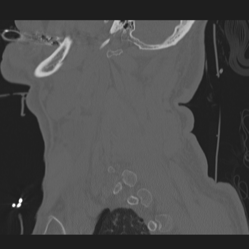 File:Occipital condyle fracture (Radiopaedia 33467-34517 Sagittal bone window 61).png
