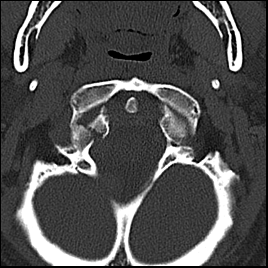 Occipital condyle fracture (type 1) (Radiopaedia 87670-104084 Axial bone window 13).jpg