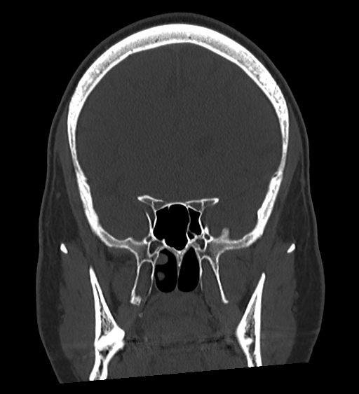 Occipital spur and Currarino type A atlas anomaly (Radiopaedia 87027-103285 Coronal bone window 64).jpg