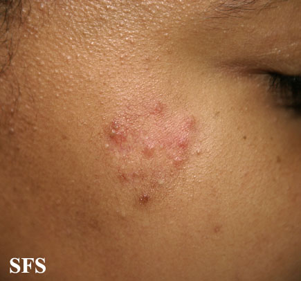 File:Sarcoidosis (Dermatology Atlas 11).jpg