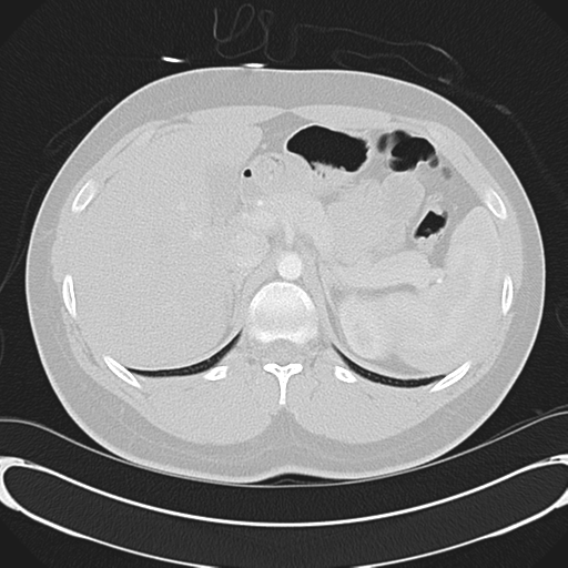 'Bovine' aortic arch (Radiopaedia 33554-34637 Axial lung window 66).png